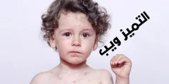 ما هي أعراض مرض الحصبة عند الأطفال وأسبابها وعلاجه